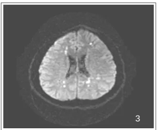 Figure 4.  On the 13th hospital day, analysis of BAL  fluid  revealed  fat-containing  (lipid-laden)   macro-phages (oil red O stain, X1000)