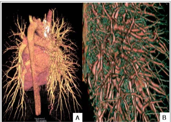 Figure 4.  3-Dimentionally reconstructed CT scan showed diffuse pulmonary arteriovenous malformations on the  right Lung.(A) Magnified Image of the right Lung (B)