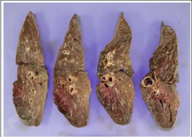 Figure 5.  The specimen showed geographic hemor- hemor-rhage  in  the  superior  segment  of  lower  lobe