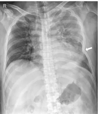 Fig. 1. Initial chest radiography shows left multiple rib frac- frac-tures with a depressed sixth rib (arrow).