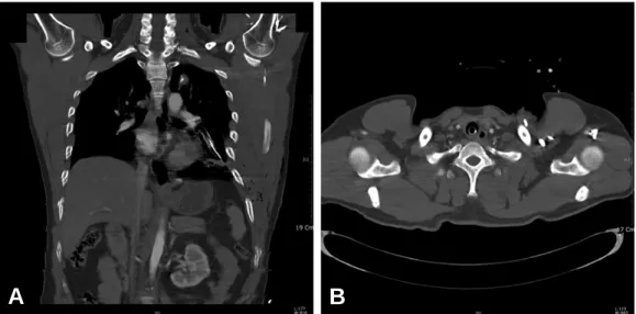 Fig. 1. A computed tomographic scan of chest. Arrows indicate fracture of left first rib