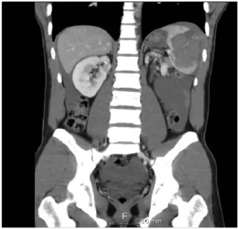 Fig. 1. Abdominal compute tomography finding reveal splenic rupture, perisplenic and perihepatic fluid collection, and large amount of hematoma.