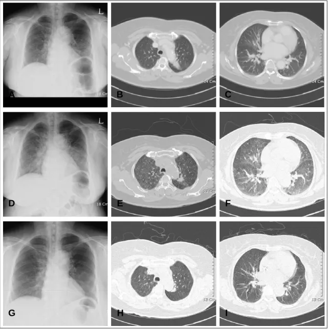 Figure 2.  Chest X-ray and chest CT showed that the primary malignant mass in LUL with atelectasis (Figure 2A)  and mediastinal lymphadenopathy (Figure 2B, 2C)