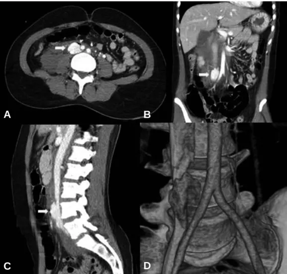 Fig. 1. Computed tomography showed laceration of infrarenal IVC with active bleeding (arrow).