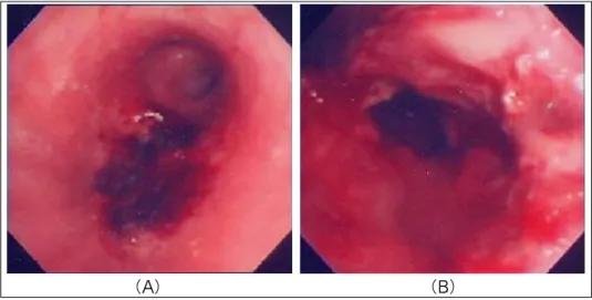 Figure 2.  (A) Bronchoscope shows ulcerative mucosal lesions with necrosis on the distal portion of the left main  bronchus and the left lower lobe bronchus