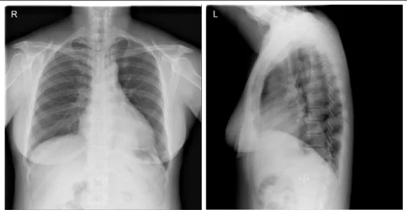 Figure 1.  Chest radiography showed mass like lesion with passive atelectasis in left lower lobe