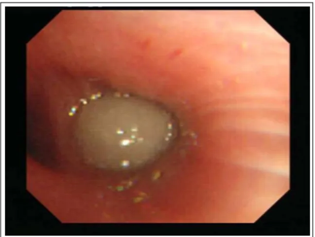 Figure  3.   Bronchoscopy  showed  yellowish,  round,  hard  mass,  completely  obstructing  left  lower  lobe  bronchus.