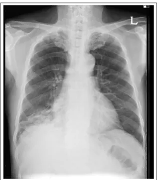 Figure  1.   Chest  radiograph  shows  right  infrahilar  mass-like opacity and Dense pneumonic infiltrates at  lower portion of right middle lobe and lower lobe.
