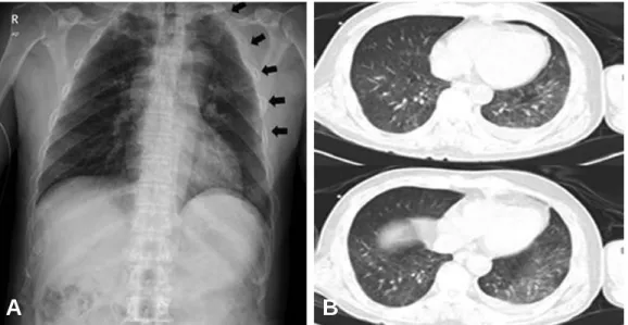 Fig. 1. Initial radiologic evaluation. (A) Chest AP demonstrates multiple rib fractures including 5 ribs of left lung