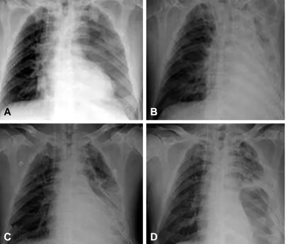 Fig. 3. Computed tomography findings. (A) No visible diaphragmatic rupture or organ herniation on initial evaluation (B) Diaphragmatic rupture with organs (stomach (S), spleen (N)) herniation was noted on 11th hospital day (C) Diaphragmatic  rup-ture with 