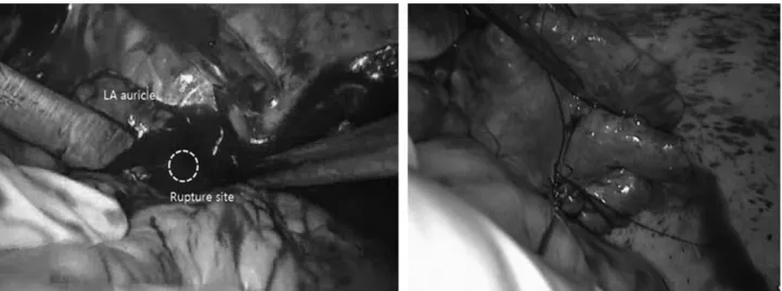 Fig. 1. A 36 years old man with blunt chest trauma because of falling down from the 4 th floors had hemopericardium