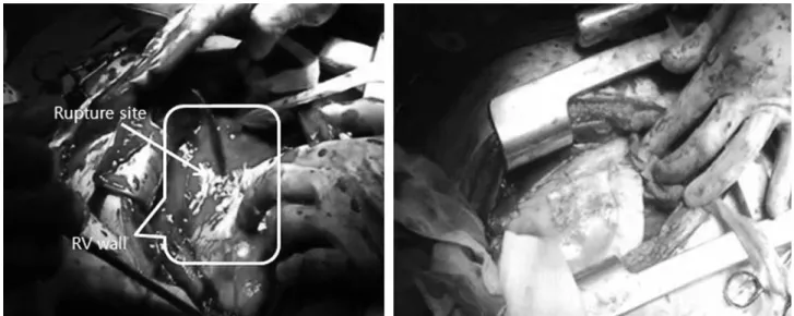 Fig. 2. A 71 years old man with blunt chest trauma due to motor vehicle accident had active bleeding after opening of the pericardi- pericardi-um