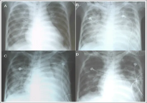 Figure 3.  Serial follow up of chest X-ray. A: At admission, diffuse hazy infiltration was noted on right lung field