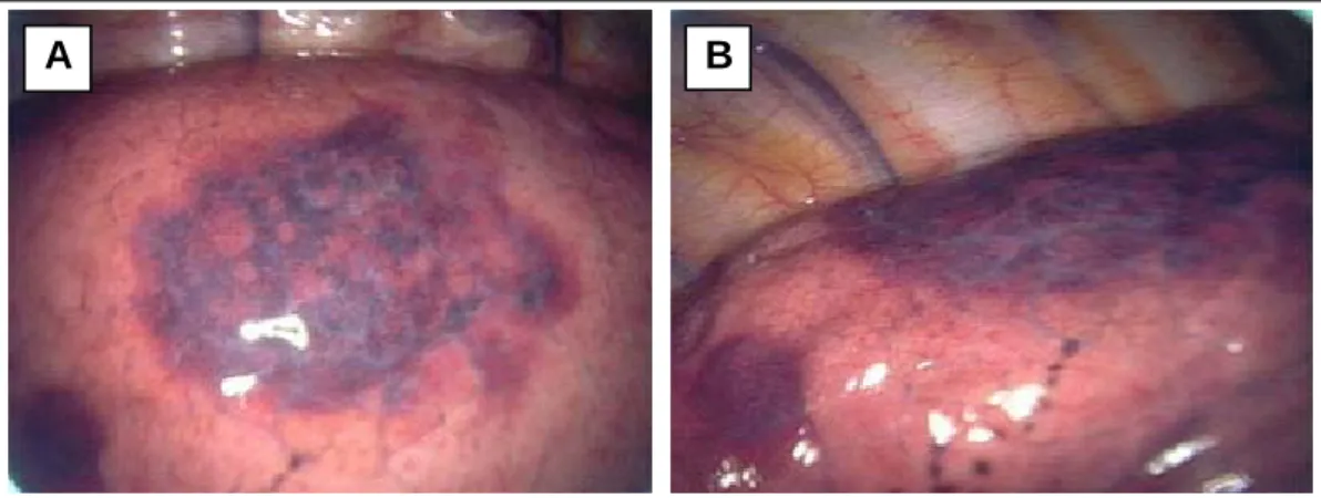 Figure 3. (A)(B)  Thoracoscopic examination showed the lesions of recurrent bleeding area that were one large  dark reddish lesion and nearby three smaller lesions in the posterior basal segment of RLL.