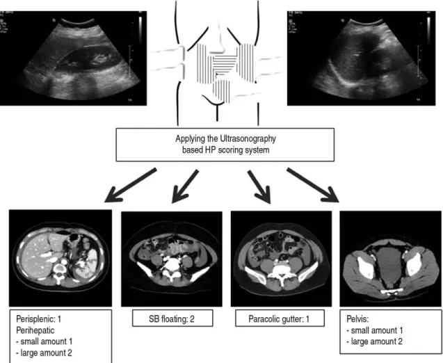Fig. 1. Applying the Ultrasonography-based hemoperitoneum scoring system.