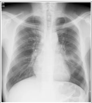 Figure 2.  Chest Computed tomography(CT) shows 5  cm  sized  Left  hilar  mass  invading  pericardium  with  lymphadenopathy