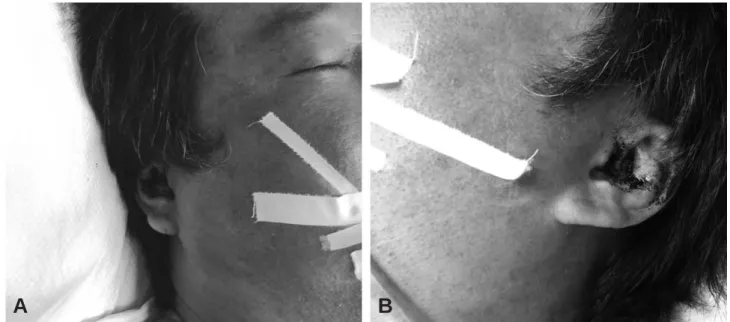 Fig. 2. (A) Right and (B) Left ear bleeding without direct injury.