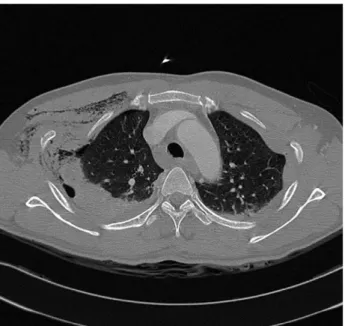 Fig. 3. Computed tomography demonstrates hemopneumotho- hemopneumotho-rax, multiple rib fractures and lung contusion.