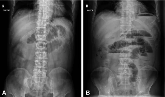 Fig. 1. Supine (A) and erect (B) simple X-ray shows dilated small bowel loops with step ladder sign.