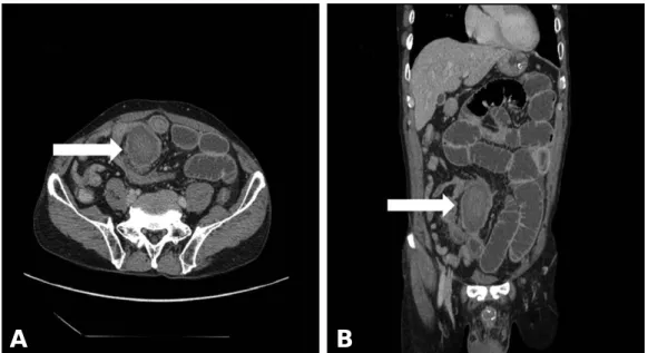 Fig. 2. Axial (A) and coronal (B) view of the abdominal computed tomography scan. Tumor-like lesion (white arrow) with intestinal obstruction is noted at level of terminal ileum.