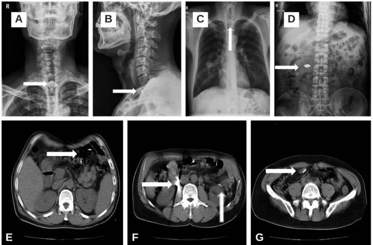 Fig. 1. Plain radiographs (A, B, C, D) show multiple fragments of cutter knife (white arrow) and also, computed tomography scans (E, F, G) show them in alimentary tract at admission.