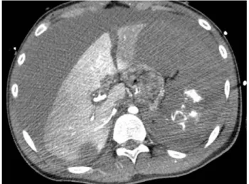 Fig. 1. The initial CT image. Hemoperitoneum is seen but infe- infe-rior vena cava is not collapsed.
