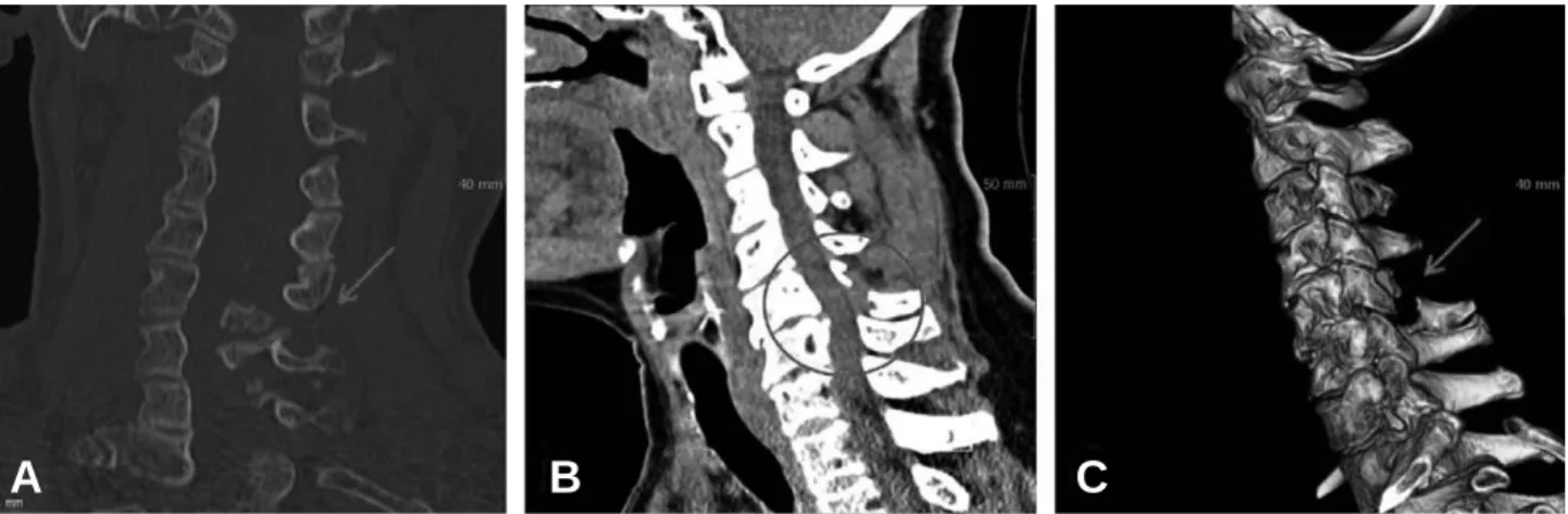 Fig. 1. Cervical spine CT scan demonstrates subluxation of facet joints at C5-6 (A), transdiscal unstable injury at C5-6 (B) and frac- frac-ture of spinous process of C5 vertebra (C).