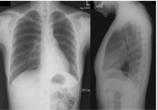 Figure 1.  Chest PA shows atelectasis on left lower lobe.