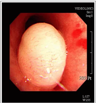 Figure 3.  Bronchoscopy shows a whitish ovoid mass  with smooth-surface, which almost obstructs the distal  left main bronchus