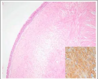 Figure  5.   Microscopy  shows  a  submucosal  leiom- leiom-yoma  composed  of  spindle-shaped  smooth  muscle  cells  (H&amp;E,  ×100),  which  are  strongly  positive  to  smooth muscle actin (Inset : ABC, ×400).