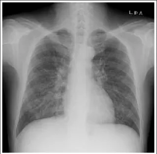 Figure 3.  Bronchoscopy shows diffuse engorgement  of the mucosal vessels and slight edema.