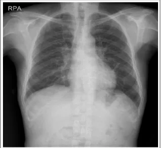 Figure  1.   Chest  X-ray.  Diffuse  bilateral  mixed  fine  reticular  and  poorly-defined  micronodular  opacities  are distributed at both lung fields.