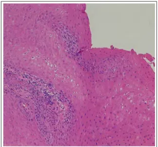 Figure 4.  Open surgical lung biopsy (H&amp;E staining,  x40).  Diffuse  and  nodular  infiltrations  of  interstitial  lymphoplasma cells are revealed in peri-bronchiolar  and peri-vascular spaces