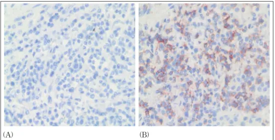 Figure 6.  Immunohistochemical stain of open lung biopsy. (A) CD4+ T- lymphocytes are abscent, and (B) CD8+ 