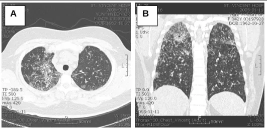 Figure  1.   Chest  PA  shows  somewhat  enlarged  bilateral  hilar  shadow  and  diffusely  increased  bronchovascular markings in both lungs.