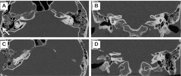 Fig. 2. Preoperative (A, B) and postoperative (C, D) HRCT images of patient no. 1, longitudinal fracture line (white arrow) of the temporal bone in axial view of the right temporal bone (A), Traumatic fluid collection of both mastoids and right middle ear 