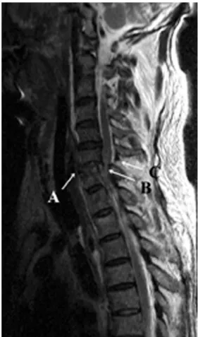 Fig. 1. Preoperative MRI of a traumatic cervical spine at C6-7 Sagittal T2-weighted image shows the disruption of the ALL (A) and intervertebral disc