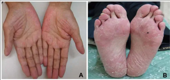 Figure 5.  Paronychia with granulation tissue on the fingernail (A) and  toenail (B).