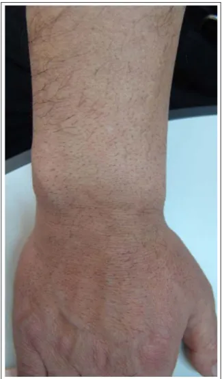 Figure 7.  Intertrigo on the popliteal area.