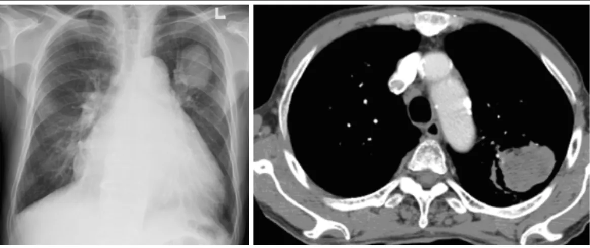 Figure 5.  Several months later, the size of mass increased in chest radiograph and CT scan