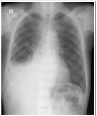 Figure 1.  Chest X-ray showed no definitive paren- paren-chymal lesions. Pleural effusion was located in right  lung.