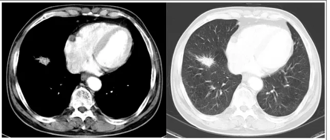 Figure 2.  Chest CT scan shows a 3.3 ×  1.7cm sized nodule with spiculated margin in anterior basal segment of  right lower lobe.