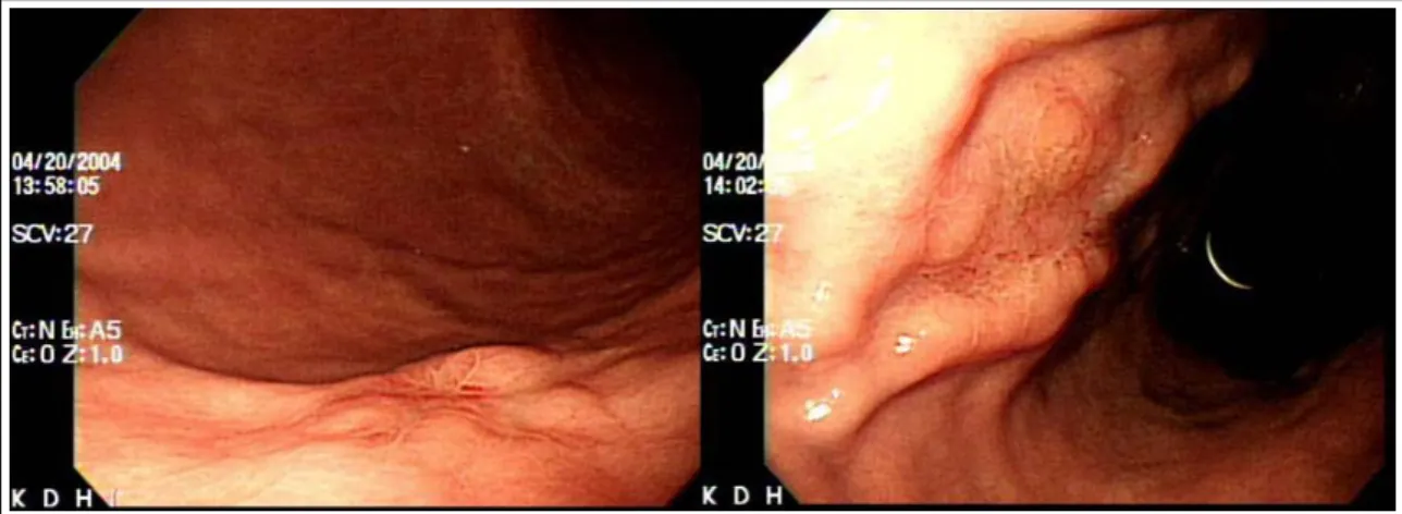 Figure 3.  Gastrofibroscopy shows 2.0 and 1.5cm sized elevated, central depressed lesions with mucosal irre- irre-gularity on the great curvature and lesser curvature of the lower body.