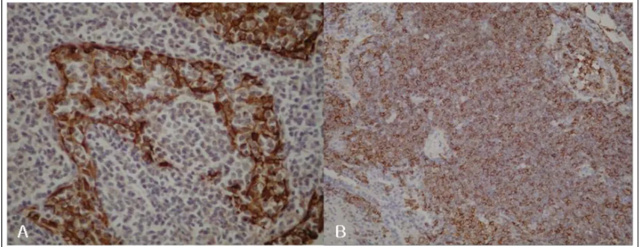 Figure  6.   Pathologic  findings  of  gastric  mucosa.  (A)  It  shows  small  to  medium  sized  lymphocytes  and  lymphoepithelial lesion (H&amp;E x 100)