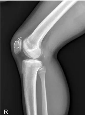 Fig. 6. Lateral radiograph after hardware removal at 6 months after the operation