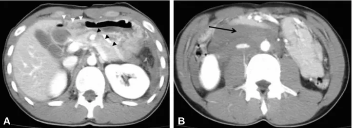 Fig. 1. Contrast enhanced abdominal computed tomography scan shows liver injury (white arrowheads of A), pancreas injury (black arrowheads of A) and retropancreatic hematoma (black arrow of B)