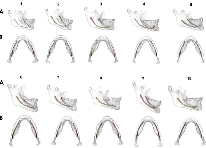 Fig. 4.  A. Lateral (A) and inferior (B) views of 10 cases of the control group with superimposed 3­dimensional models of the mandible