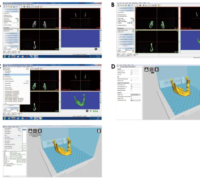 Fig. 1.  A. DICOM file imported to Simplant (Dentsply, Charlotte, NC, USA) image processing software