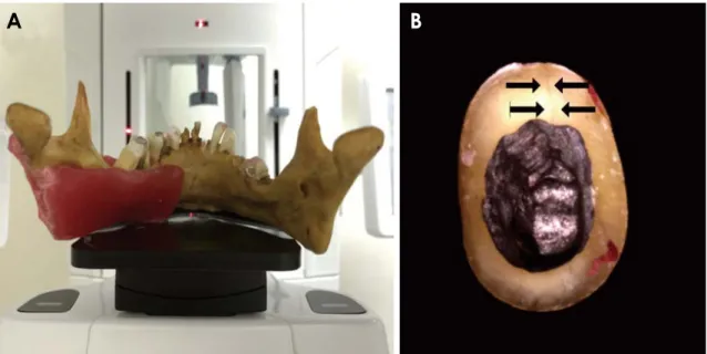 Fig. 1.  A. The phantom is positioned in the Orthopantomograph ®  OP 300. B. Premolar bonded after fracture.