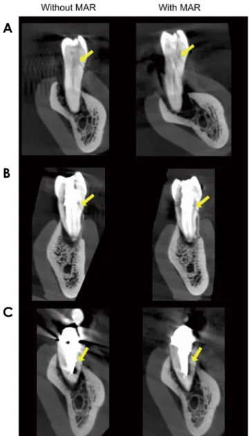Fig. 2.  Coronal slices show root fracture (arrows) in cone-beam 